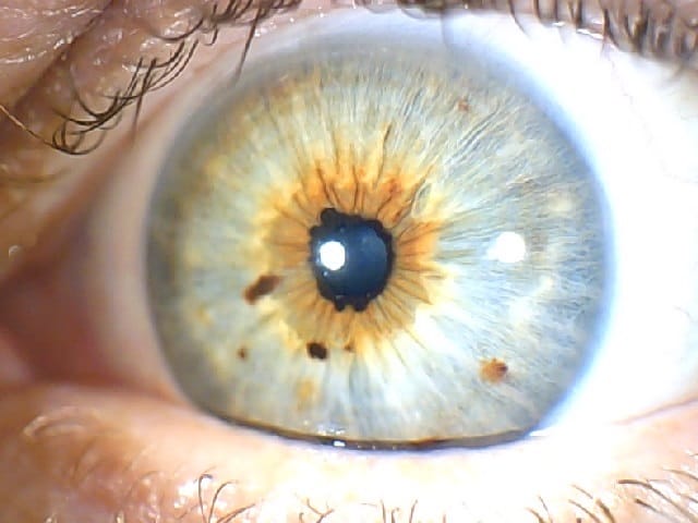 Iridology Photo Left Eye